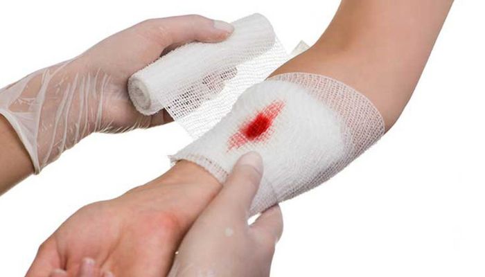 Nguyên tắc xử lý vết thương ngoài da