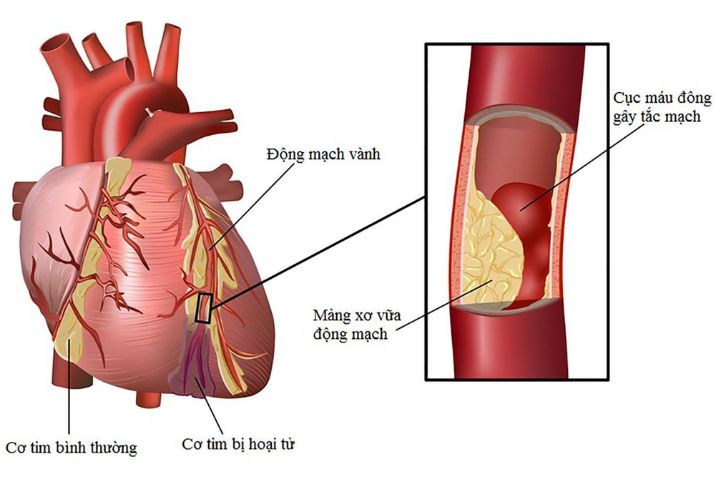 Nhồi máu cơ tim là gì? 