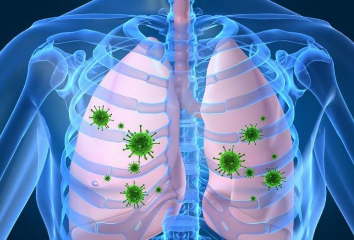 Viêm phổi là gì? 